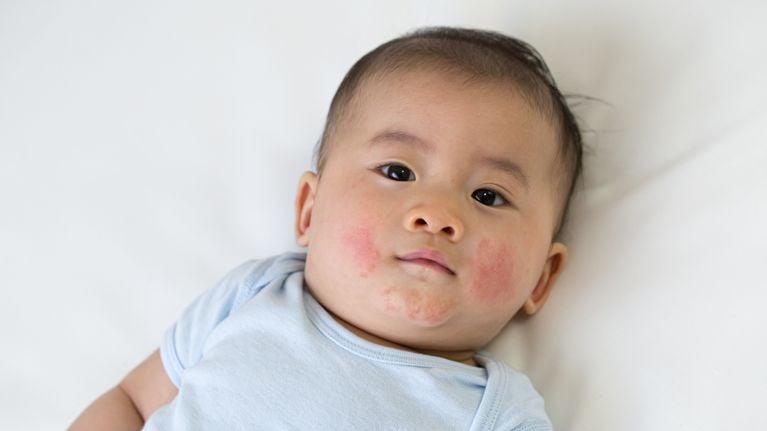 An Age-by-Age Guide to Skin Rashes and Conditions