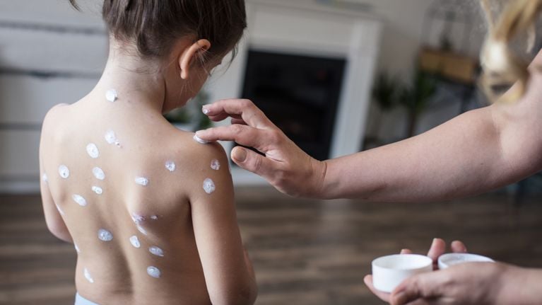 Cream is the right solution for smallpox. Mother applies daughter cream on chickenpox.