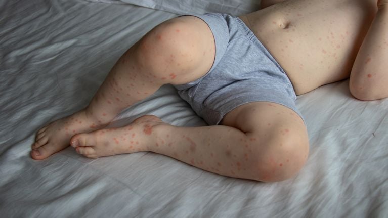 A toddler boy with rash infected by Roseola Infantum Disease. Roseola is a contagious illness that caused by a virus.