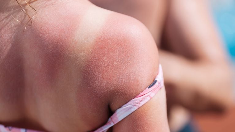 the red back of a girl with a sunburn and white lines from a swimsuit with a hotel pool on the background