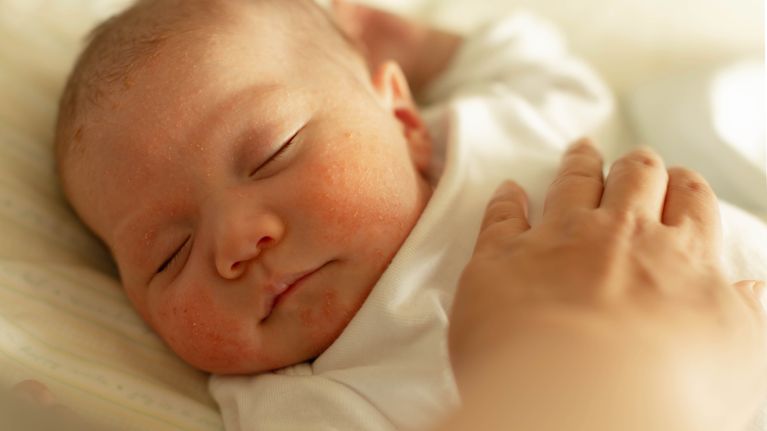 A little baby suffering from skin conditions and red bumps.