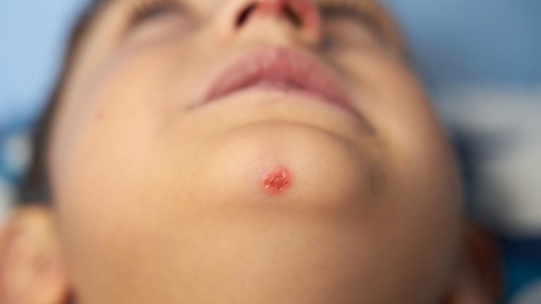 Impetigo is a common skin infection that causes blisters anywhere on the body