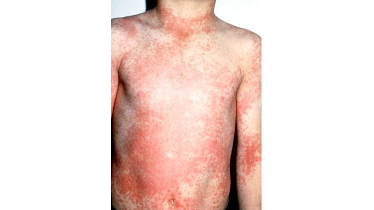 10 Common Rashes on Kids (with photos): Symptoms and Treatment