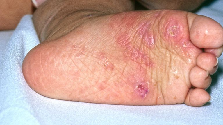 10 Common Rashes on Kids (with photos): Symptoms and Treatment