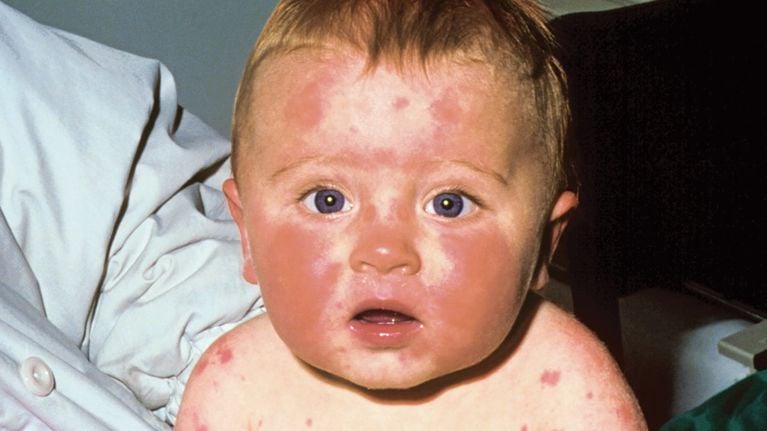 10 Common Rashes on Kids (with photos): Symptoms and Treatment