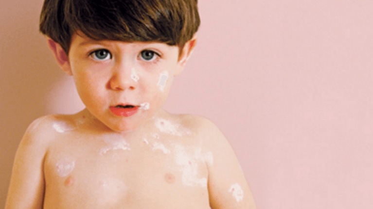 What to do if your kid gets hives